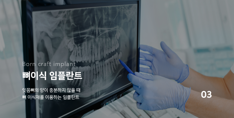 03. Born craft implant 뼈이식 임플란트 : 잇몸뼈의 양이 충분하지 않을 때 뼈 이식재를 이용하는 임플란트