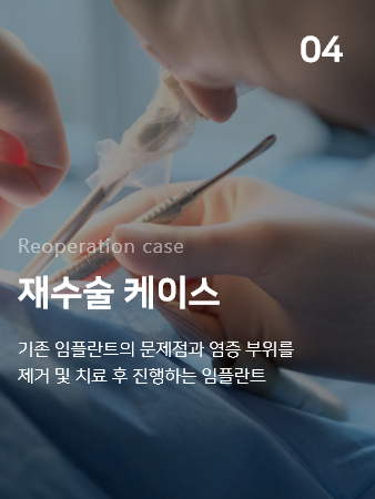 04. Reoperation case 재수술 케이스 : 기존 임플란트의 문제점과 염증 부위를 제거 및 치료 후 진행하는 임플란트