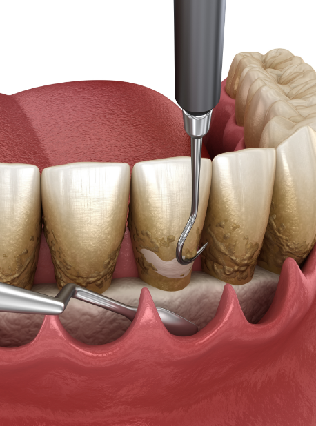 치근활택술 이미지