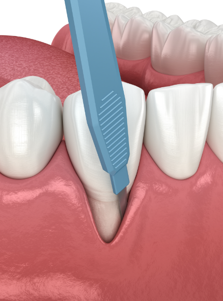 잇몸수술 이미지