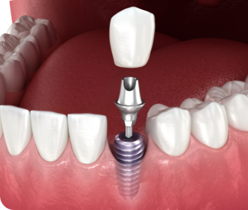 임플란트 이미지